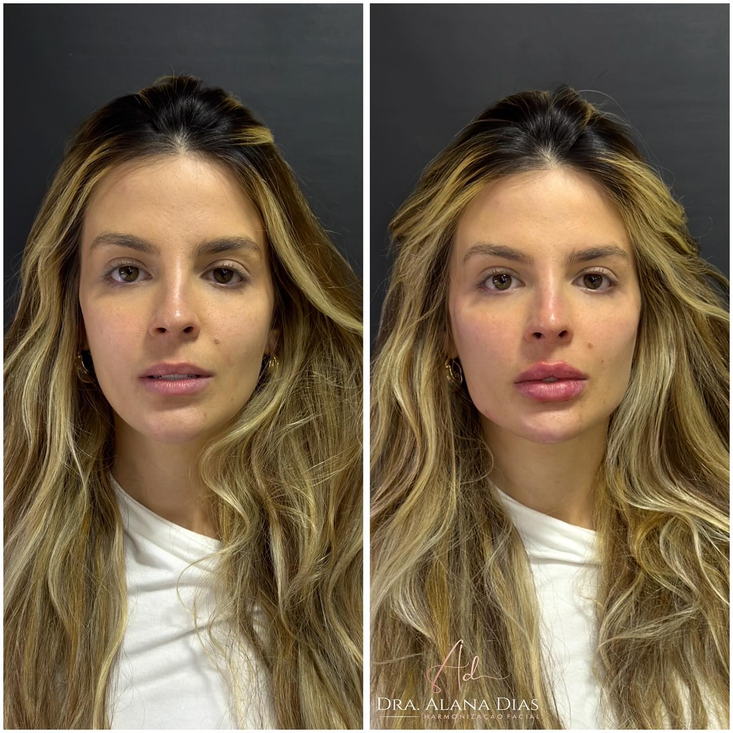 Resultado Rejuvenescimento